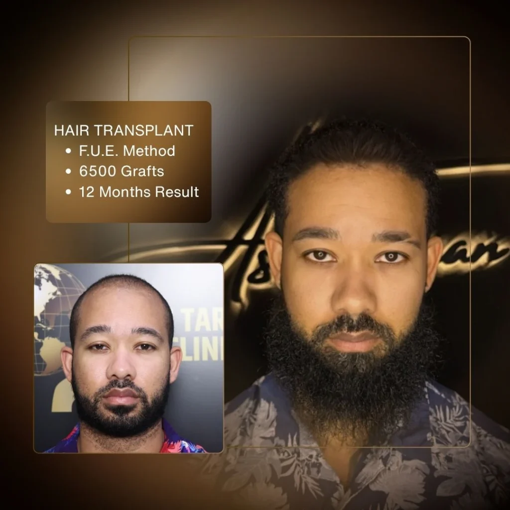 Hair Transplant Cost in Turkey 2026 1 Hair Transplant Cost in Turkey 2026