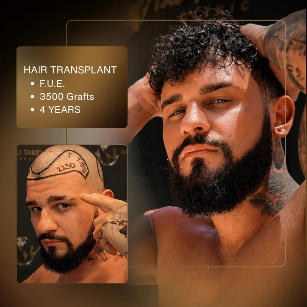 Hair Transplant Cost in Turkey 2026 6 Hair Transplant Cost in Turkey 2026