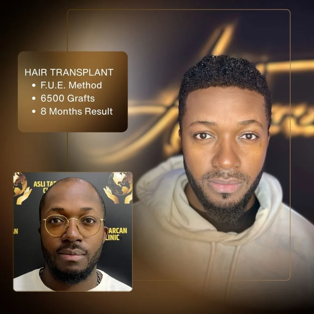 Hair Transplant Cost in Turkey 2026 7 Hair Transplant Cost in Turkey 2026