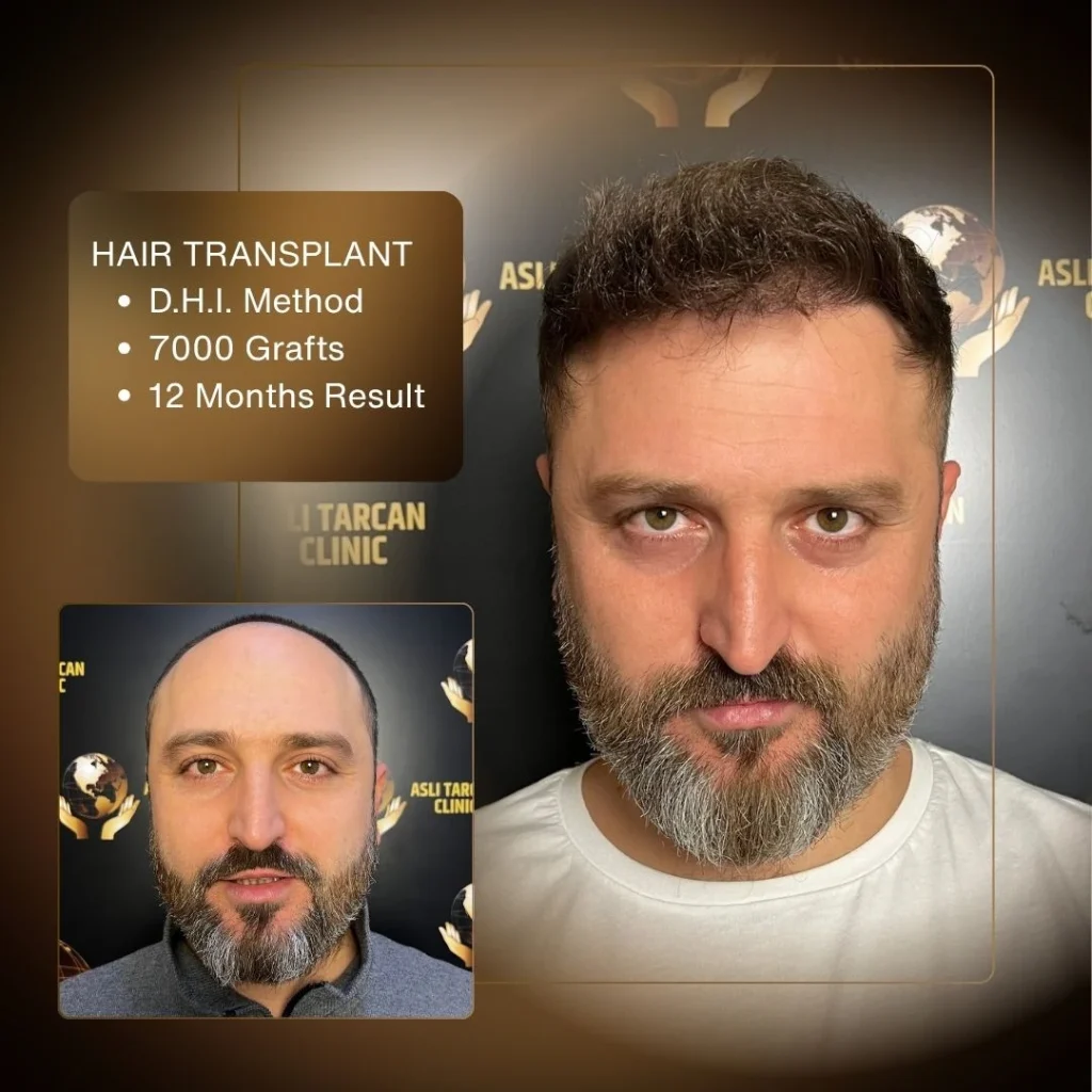 Hair Transplant Cost in Turkey 2026 3 Hair Transplant Cost in Turkey 2026
