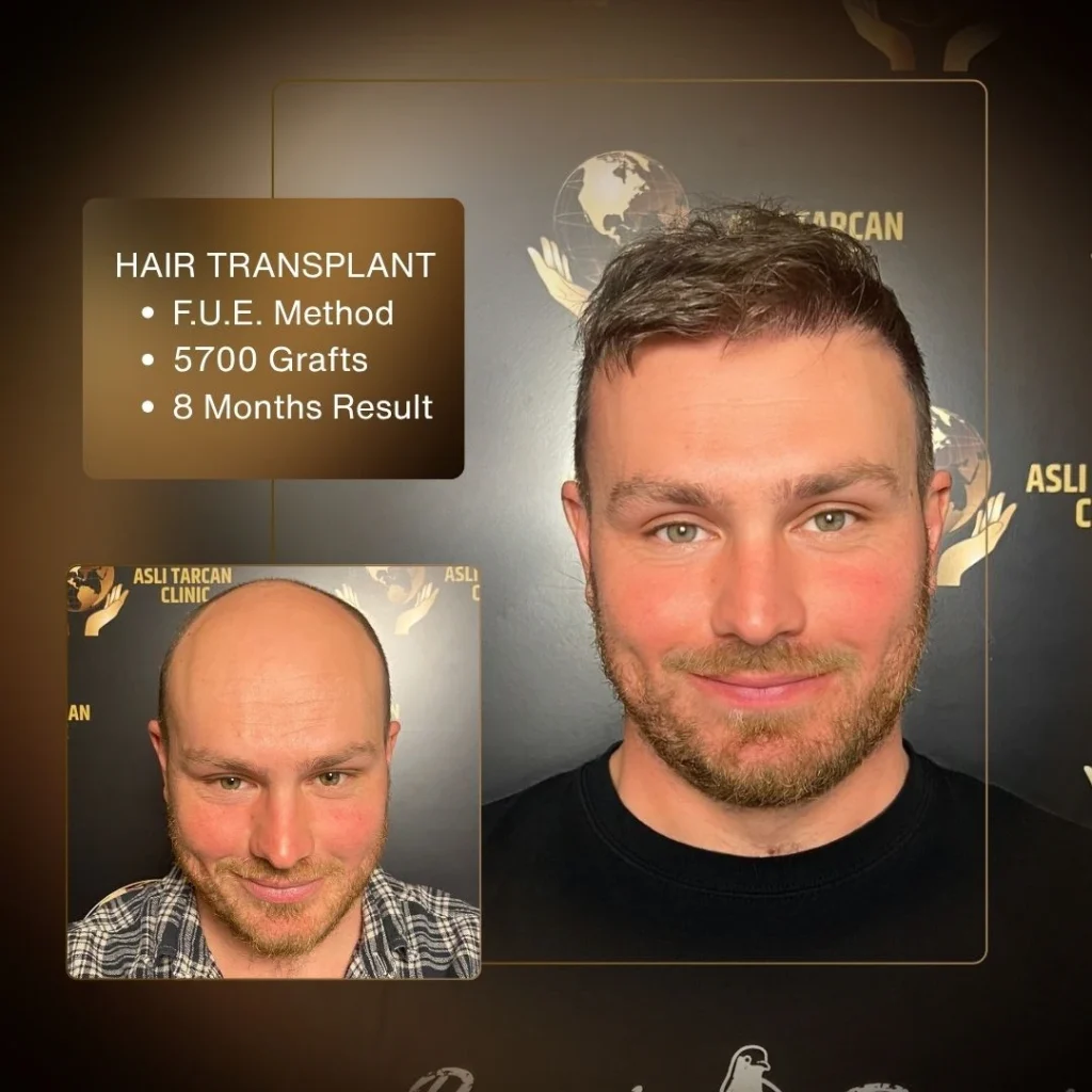 Hair Transplant Cost in Turkey 2026 2 Hair Transplant Cost in Turkey 2026
